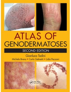 Atlas of Genodermatoses 2/e...