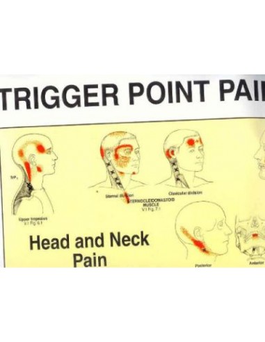 Trigger points Giant Chart Laminated...