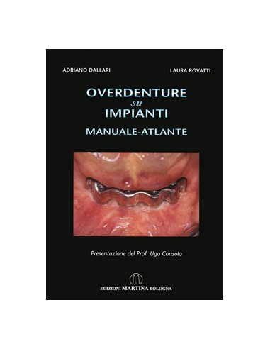 Overdenture su Impianti manuale atlante