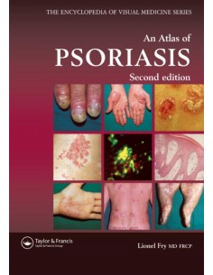 Atlas of Psoriasis...