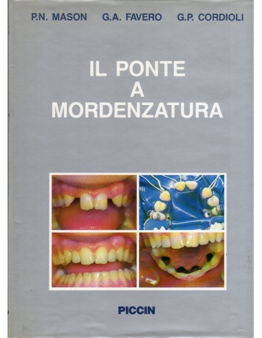 Ponte a mordenzatura (IL)