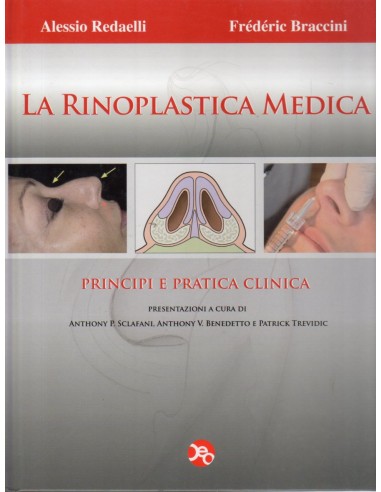 Rinoplastica medica  Principi e...