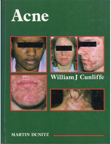 Acne