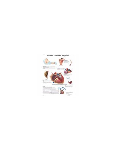 Malattie cardiache frequenti VR4343