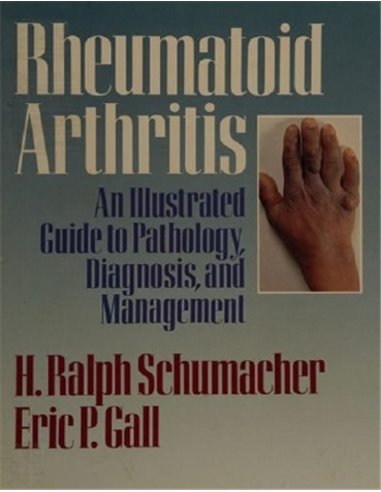 Rheumatoid arthritis