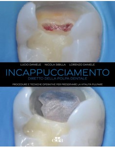 Incappucciamento diretto...